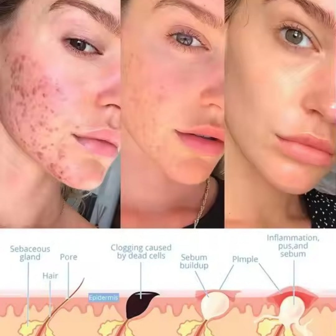 RadiantWave™ - Facial Wand